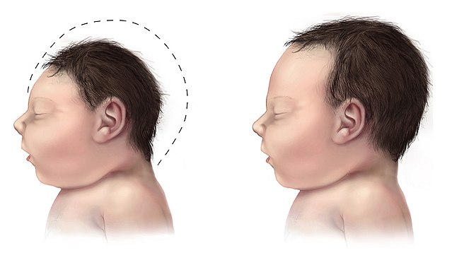 Rarest Diseases in the World